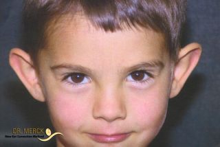 Abstehende Ohren vor OP - Bild 4